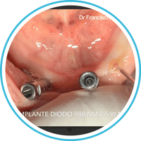Implantes ML