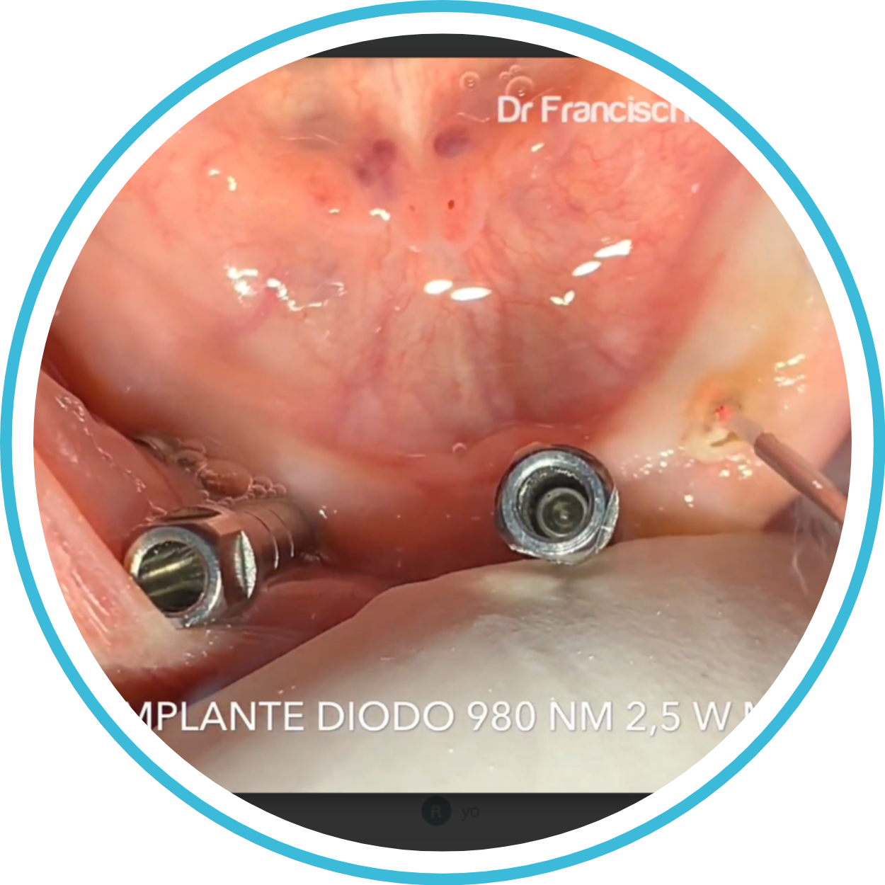 Implantes ML